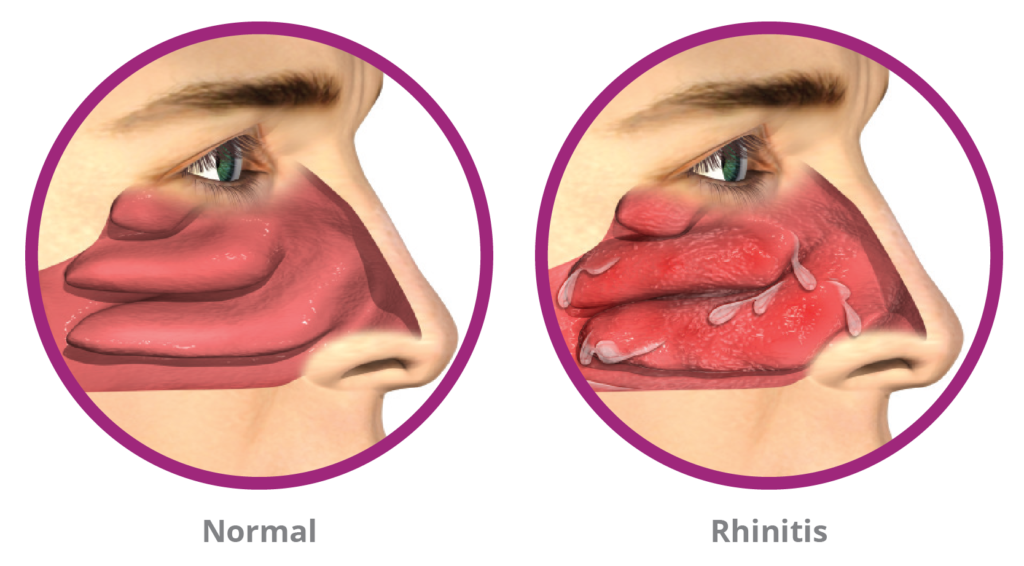 nasal conditions